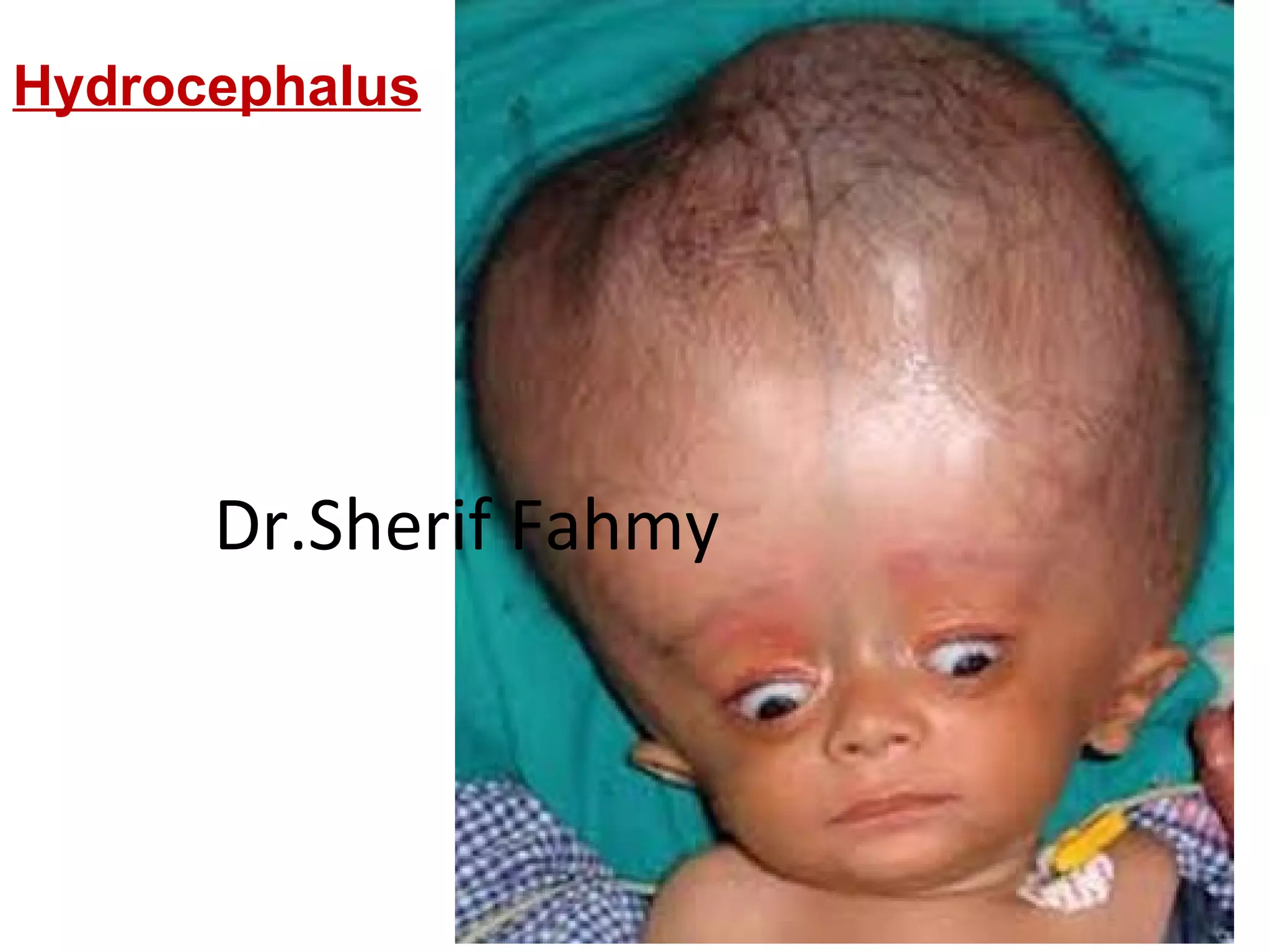 Hydrocephalus
Dr.Sherif Fahmy
 