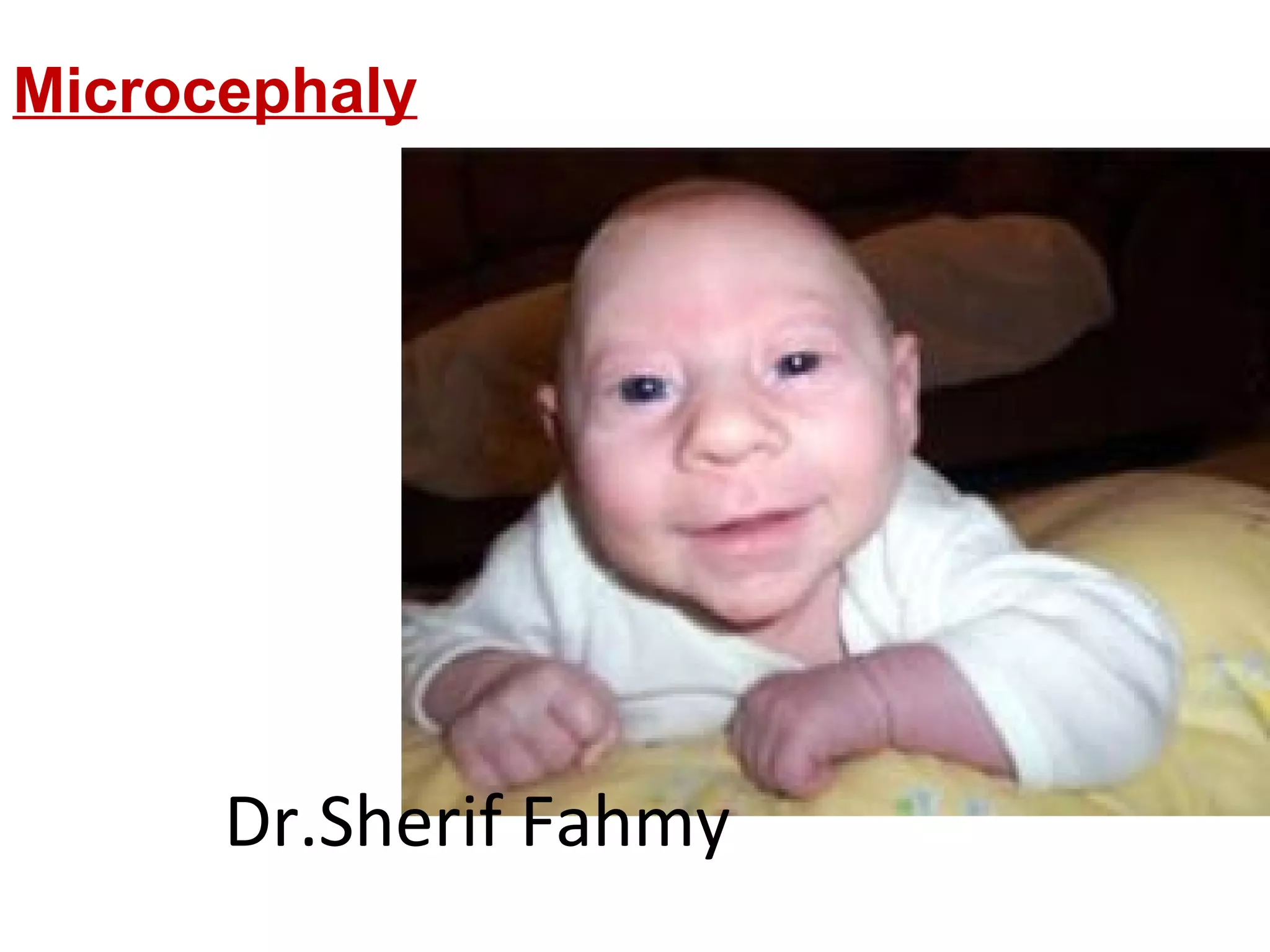 Microcephaly
Dr.Sherif Fahmy
 