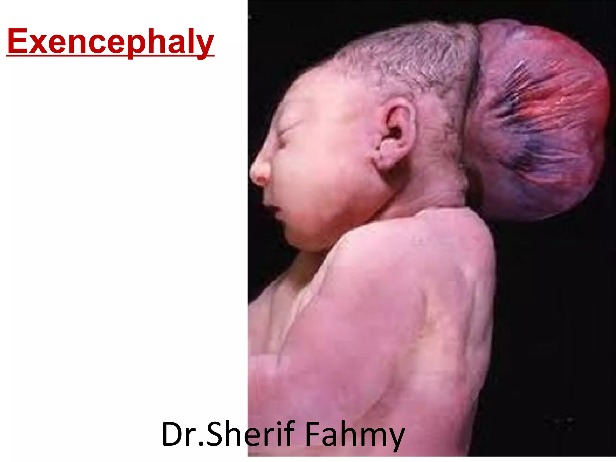 Exencephaly
Dr.Sherif Fahmy
 