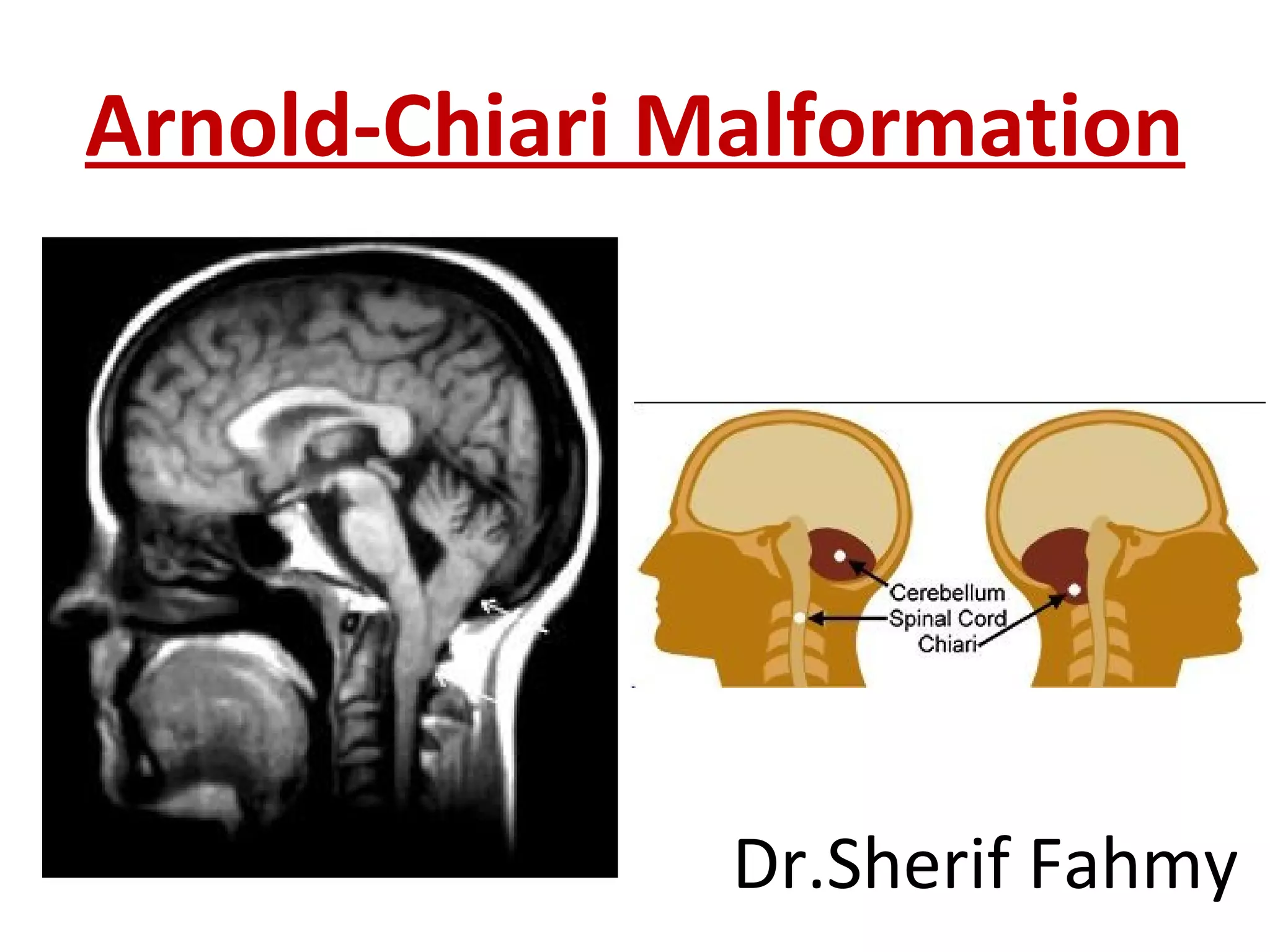 Arnold-Chiari Malformation
Dr.Sherif Fahmy
 