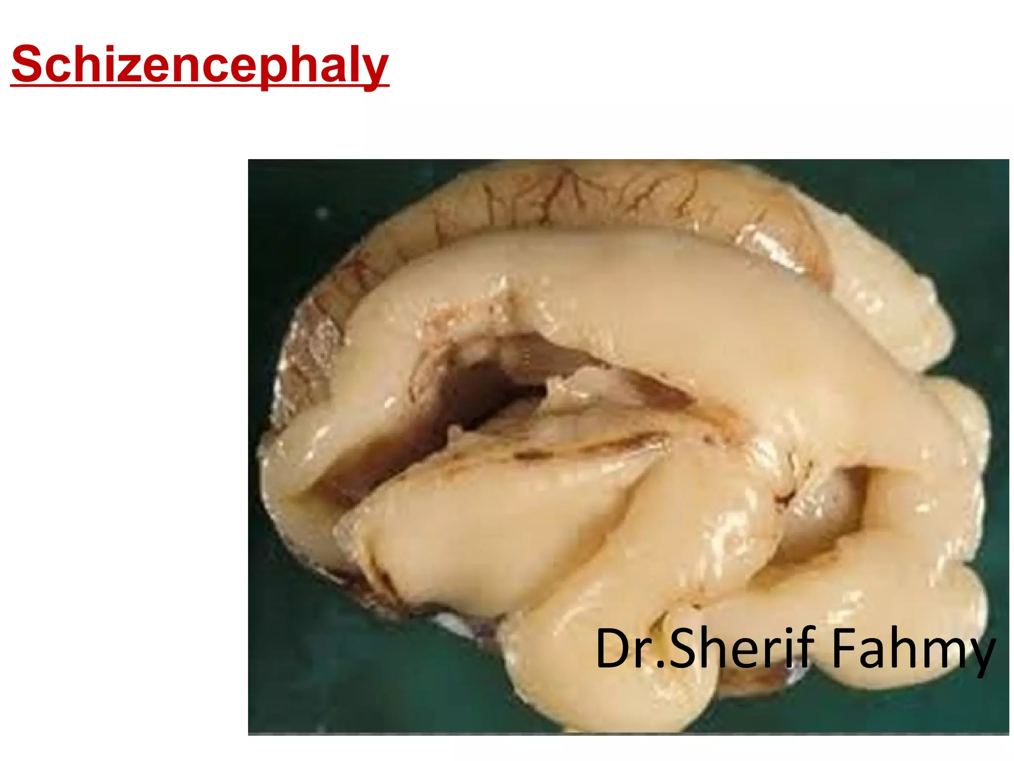 Schizencephaly
Dr.Sherif Fahmy
 
