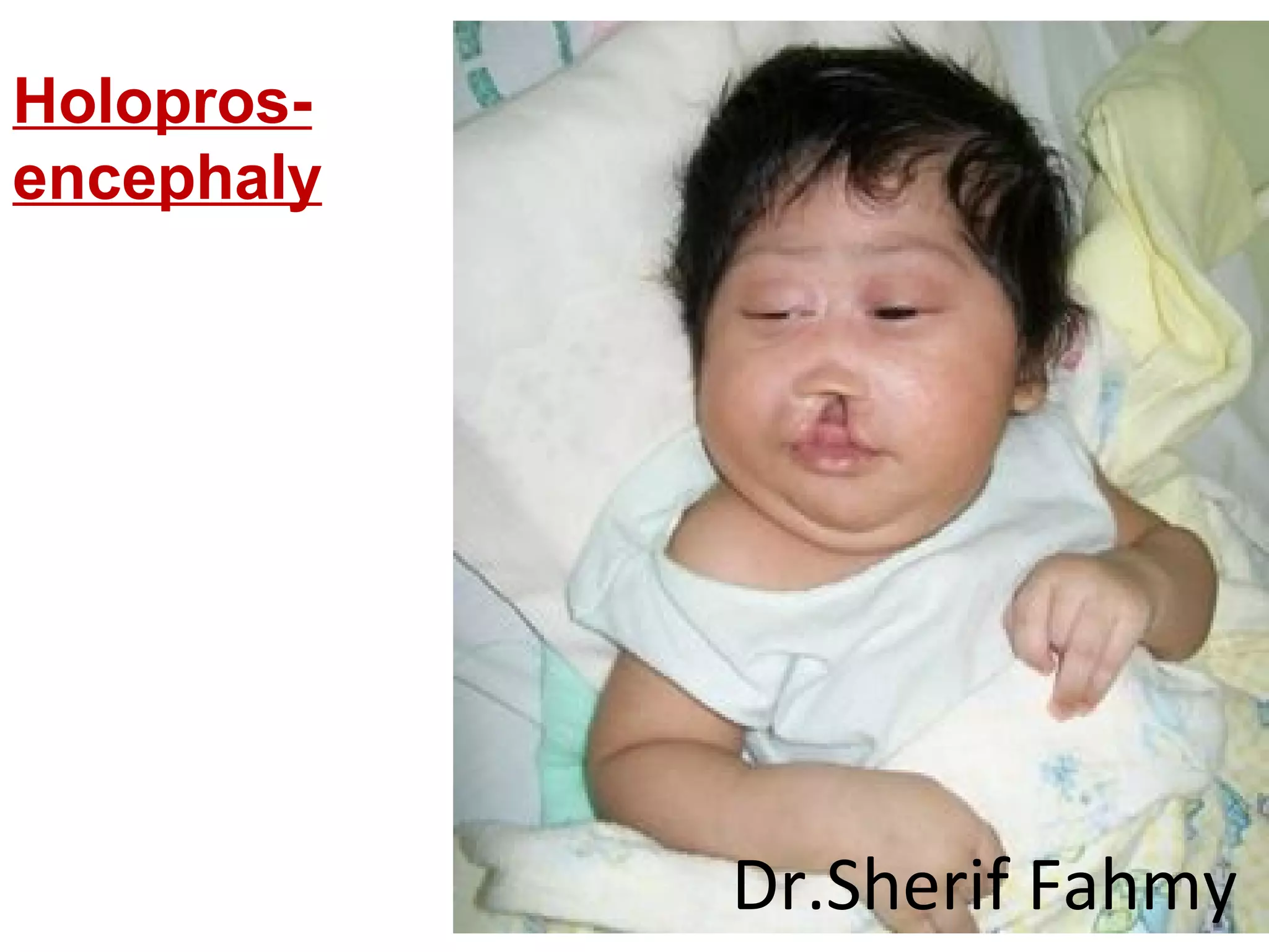Holopros-
encephaly
Dr.Sherif Fahmy
 