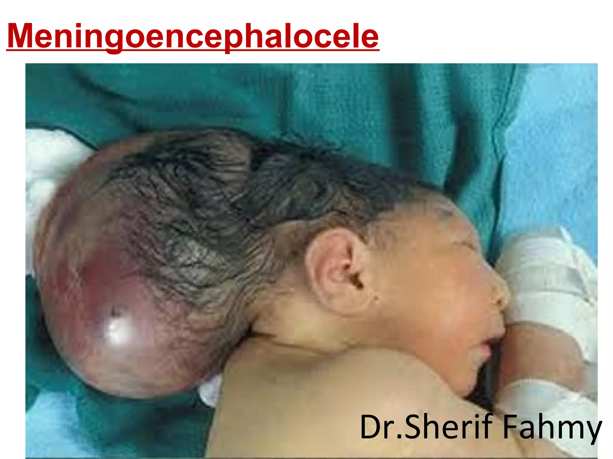Meningoencephalocele
Dr.Sherif Fahmy
 