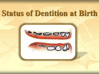 Status of Dentition at Birth
 