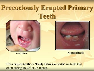 Precociously Erupted Primary
Teeth
Natal tooth Neonatal teeth
Pre-erupted teeth’ or ‘Early Infansive teeth’ are teeth that
erupt during the 2nd or 3rd month.
 