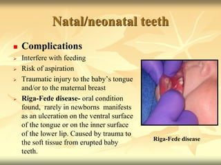 Natal/neonatal teeth
 Complications
 Interfere with feeding
 Risk of aspiration
 Traumatic injury to the baby’s tongue
and/or to the maternal breast
 Riga-Fede disease- oral condition
found, rarely in newborns manifests
as an ulceration on the ventral surface
of the tongue or on the inner surface
of the lower lip. Caused by trauma to
the soft tissue from erupted baby
teeth.
Riga-Fede disease
 