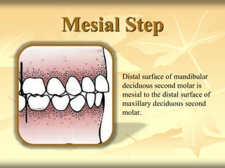 Mesial Step
Distal surface of mandibular
deciduous second molar is
mesial to the distal surface of
maxillary deciduous second
molar.
 