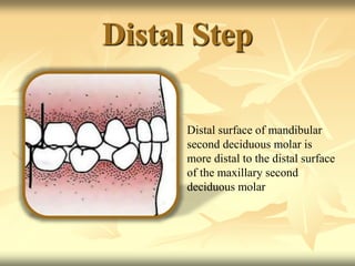 Distal Step
Distal surface of mandibular
second deciduous molar is
more distal to the distal surface
of the maxillary second
deciduous molar
 