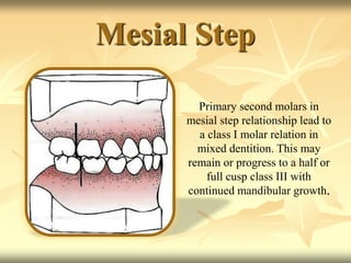 Mesial Step
Primary second molars in
mesial step relationship lead to
a class I molar relation in
mixed dentition. This may
remain or progress to a half or
full cusp class III with
continued mandibular growth.
 