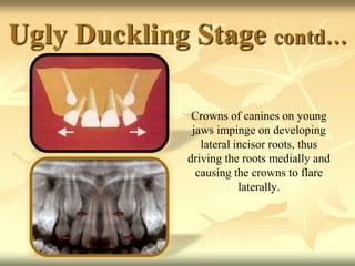 Ugly Duckling Stage contd…
Crowns of canines on young
jaws impinge on developing
lateral incisor roots, thus
driving the roots medially and
causing the crowns to flare
laterally.
 