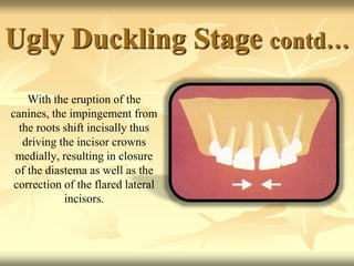 Ugly Duckling Stage contd…
With the eruption of the
canines, the impingement from
the roots shift incisally thus
driving the incisor crowns
medially, resulting in closure
of the diastema as well as the
correction of the flared lateral
incisors.
 