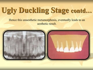 Ugly Duckling Stage contd…
Hence this unaesthetic metamorphosis, eventually leads to an
aesthetic result.
 