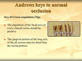 Andrews keys to normal
occlusion
Key II Crown angulation (Tip)
 The angulation of the facial axis of
every clinical crown should be
positive
 The gingival portion of the long axis
of the all crowns must be distal than
the incisal portion.
 