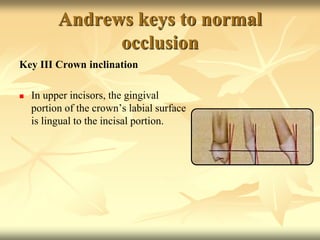 Andrews keys to normal
occlusion
Key III Crown inclination
 In upper incisors, the gingival
portion of the crown’s labial surface
is lingual to the incisal portion.
 