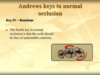 Andrews keys to normal
occlusion
Key IV – Rotations
 The fourth key to normal
occlusion is that the teeth should
be free of undesirable rotations.
 