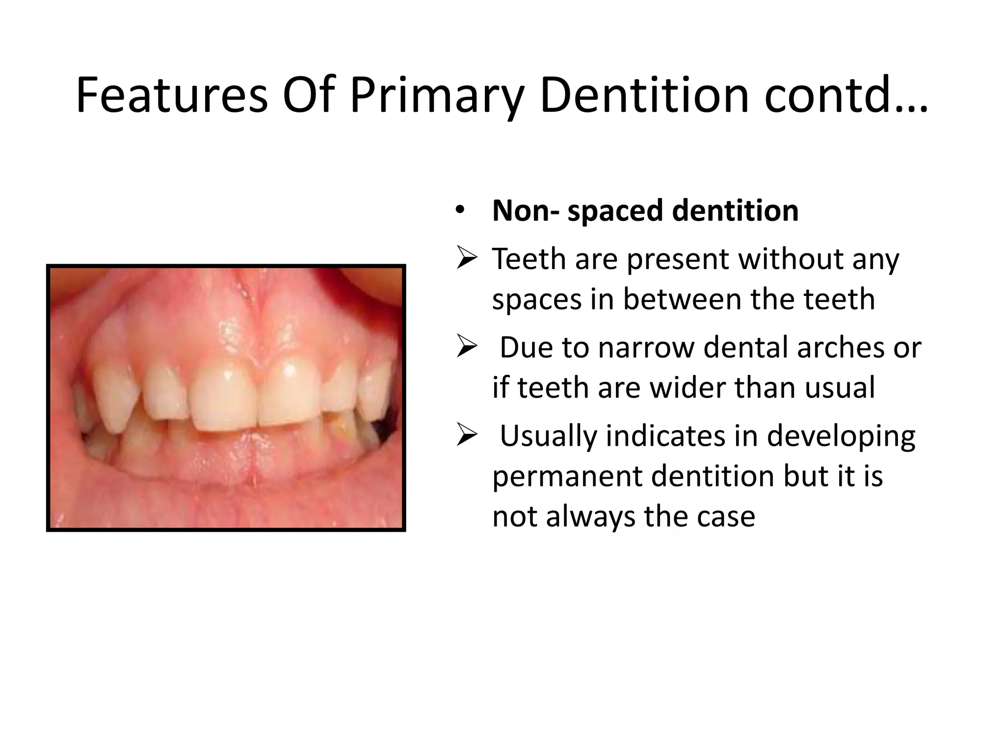 Features Of Primary Dentition contd…
• Non- spaced dentition
 Teeth are present without any
spaces in between the teeth
 Due to narrow dental arches or
if teeth are wider than usual
 Usually indicates in developing
permanent dentition but it is
not always the case
 