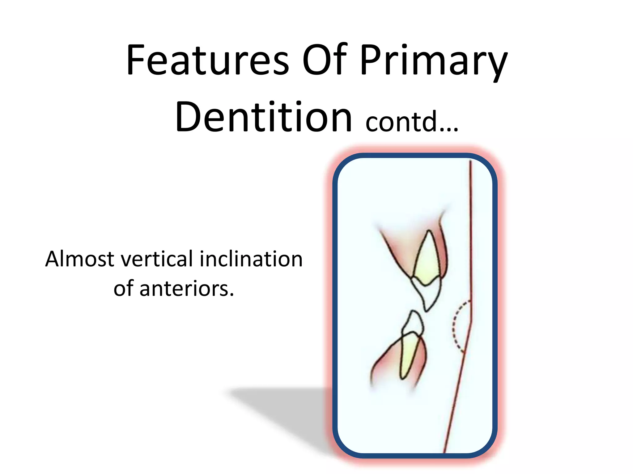 Features Of Primary
Dentition contd…
Almost vertical inclination
of anteriors.
 