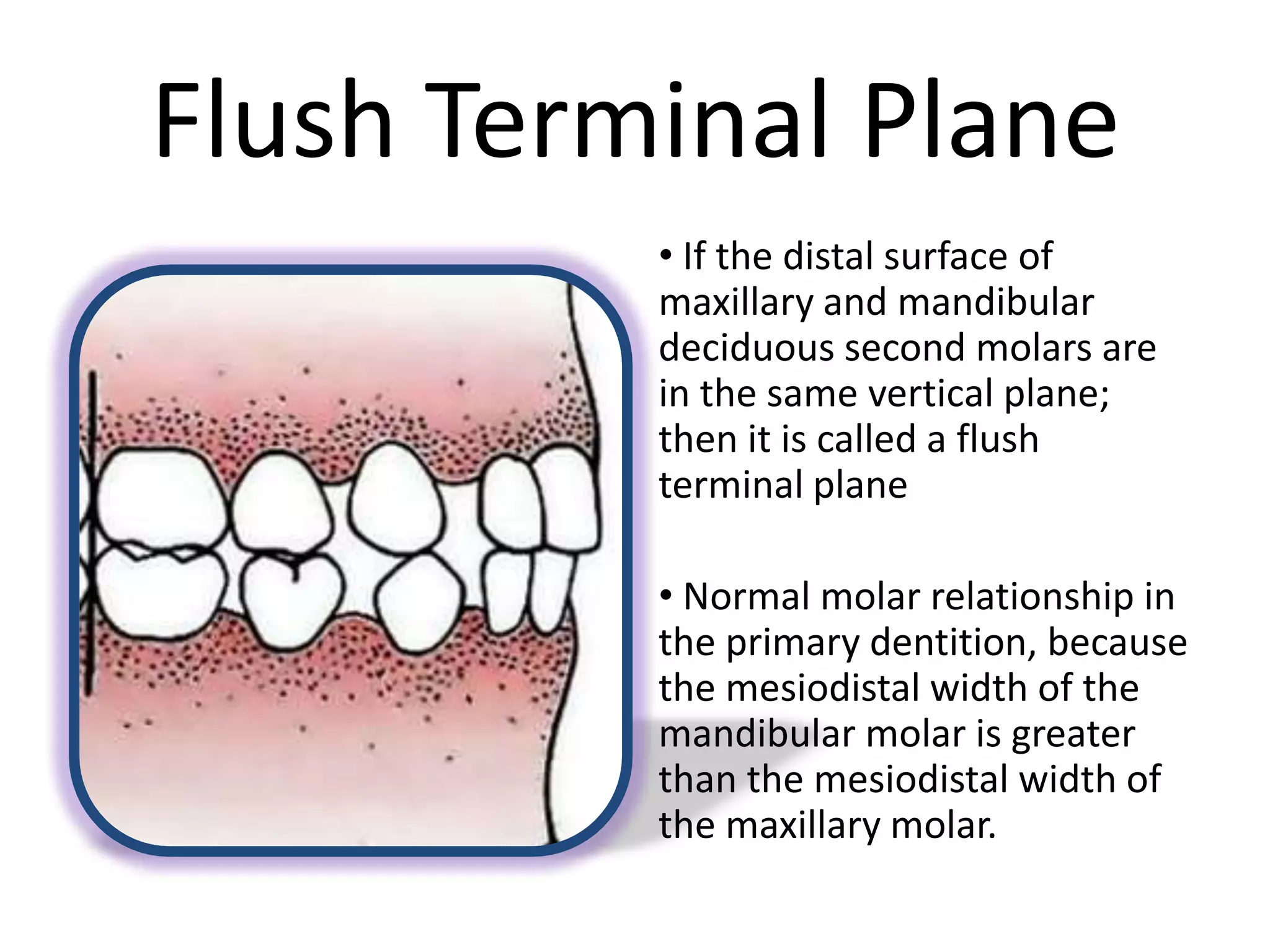 Flush Terminal Plane
• If the distal surface of
maxillary and mandibular
deciduous second molars are
in the same vertical plane;
then it is called a flush
terminal plane
• Normal molar relationship in
the primary dentition, because
the mesiodistal width of the
mandibular molar is greater
than the mesiodistal width of
the maxillary molar.
 