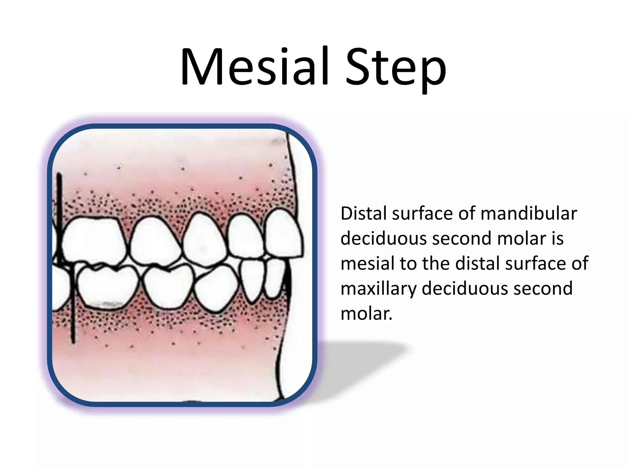 Mesial Step
Distal surface of mandibular
deciduous second molar is
mesial to the distal surface of
maxillary deciduous second
molar.
 