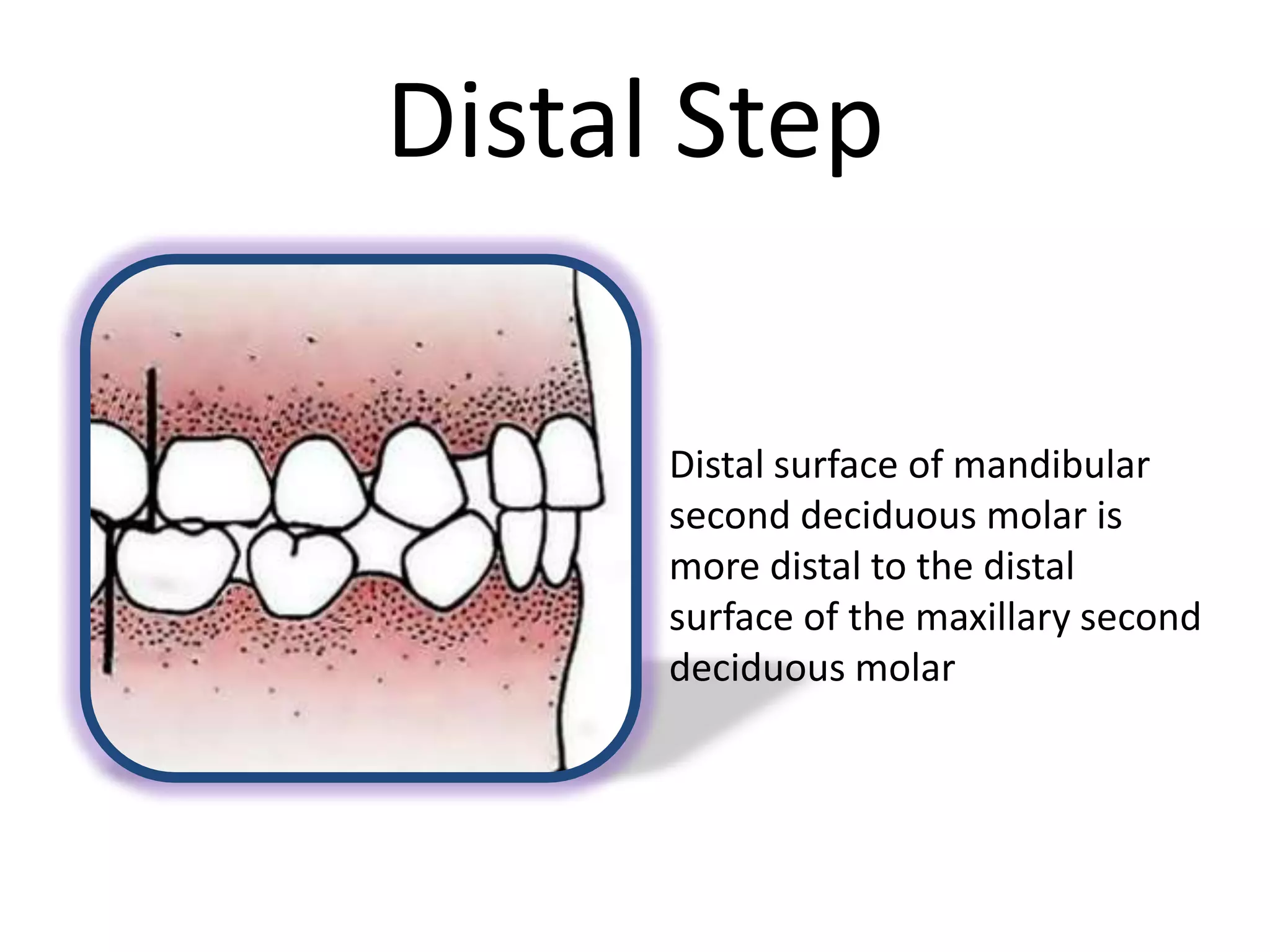 Distal Step
Distal surface of mandibular
second deciduous molar is
more distal to the distal
surface of the maxillary second
deciduous molar
 