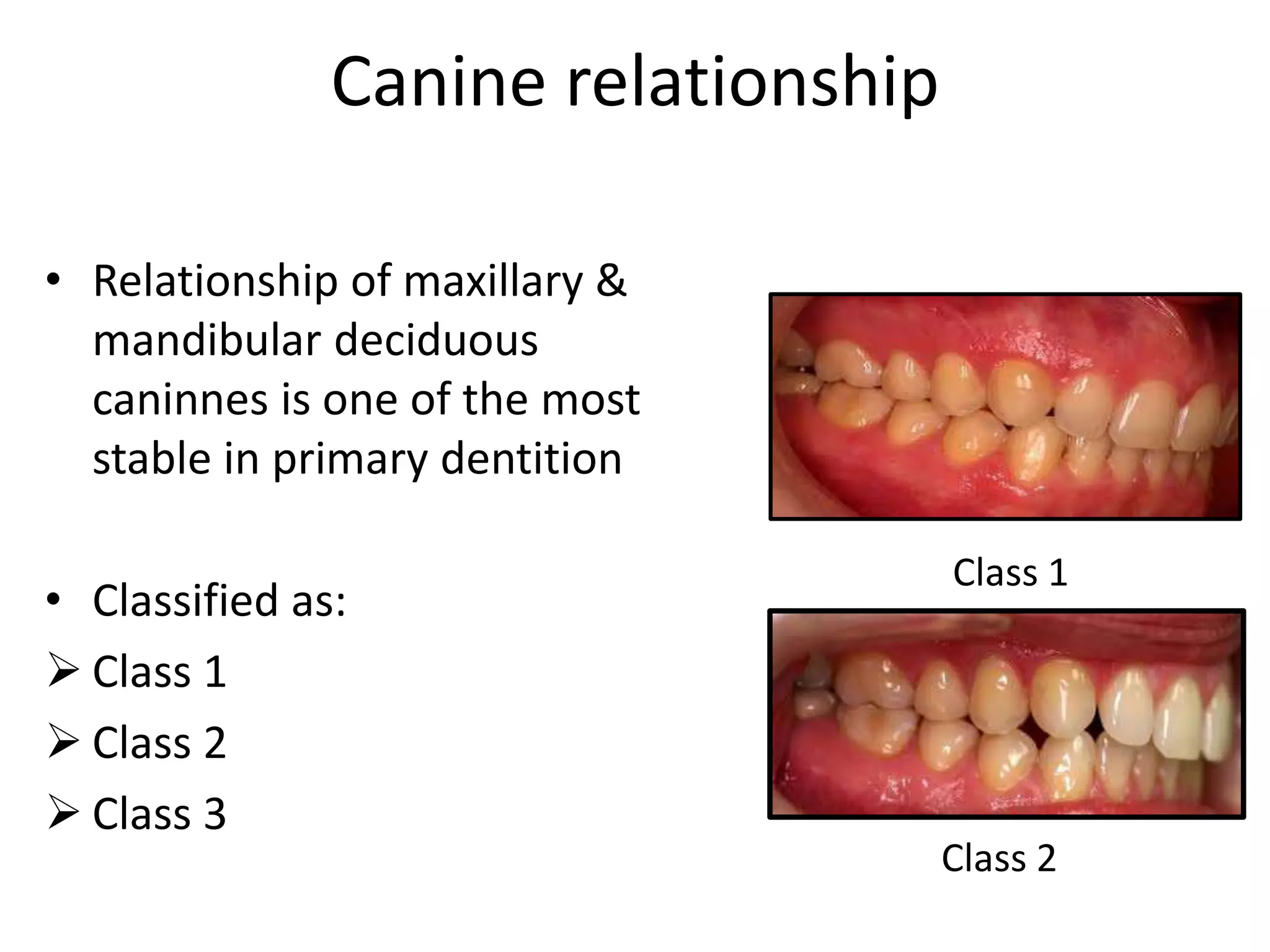 Canine relationship
• Relationship of maxillary &
mandibular deciduous
caninnes is one of the most
stable in primary dentition
• Classified as:
 Class 1
 Class 2
 Class 3
Class 1
Class 2
 
