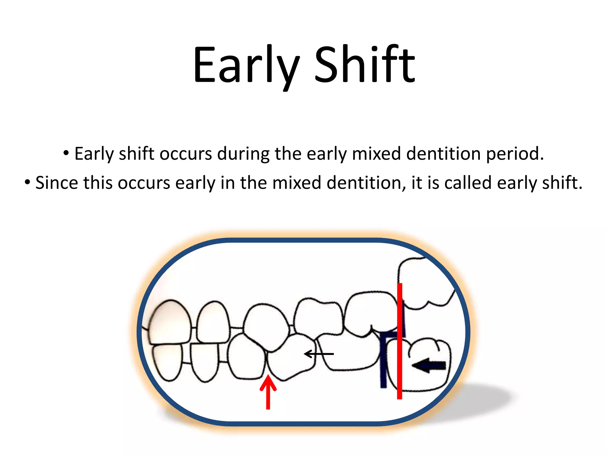 Early Shift
• Early shift occurs during the early mixed dentition period.
• Since this occurs early in the mixed dentition, it is called early shift.
 