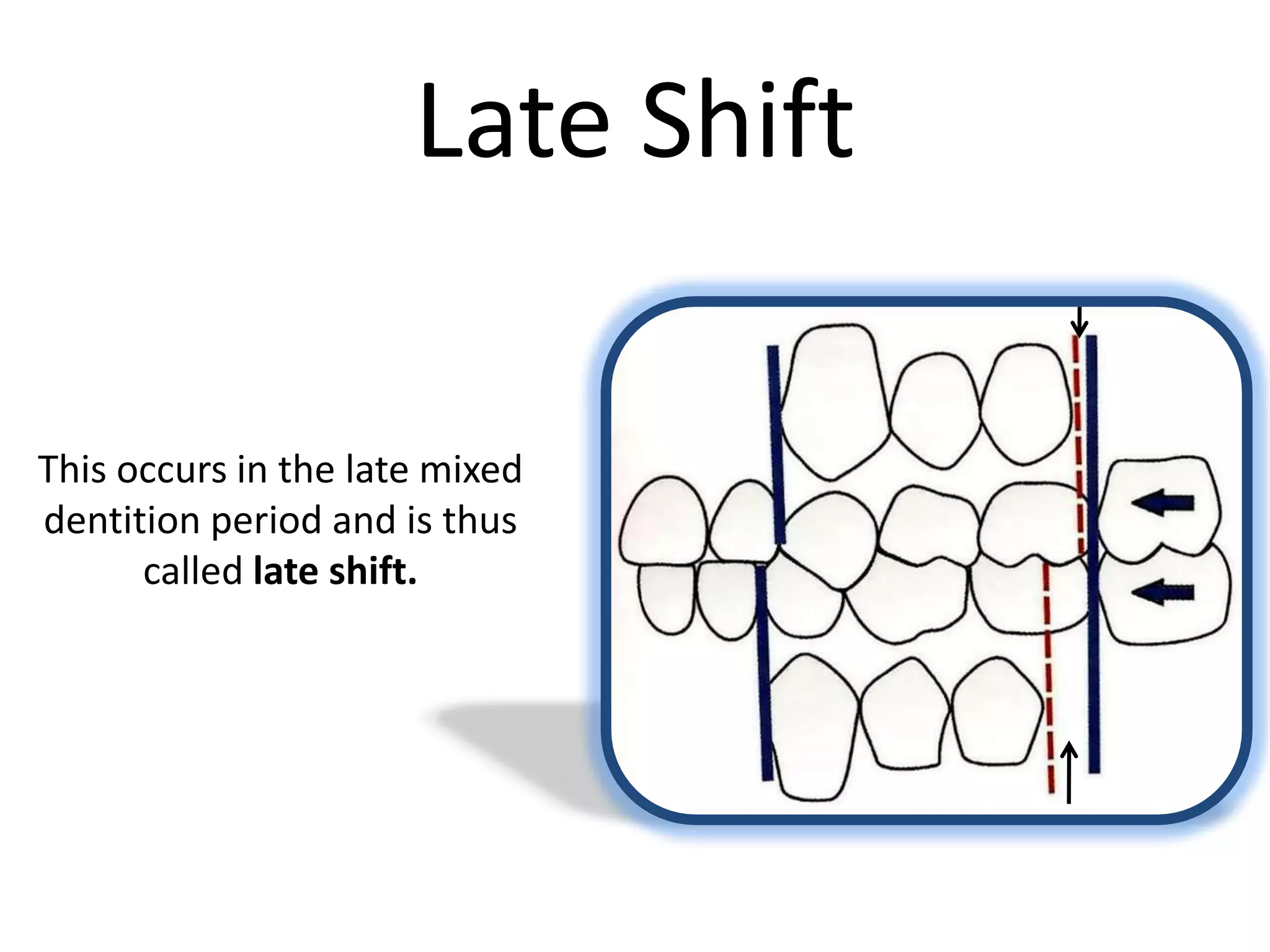 Late Shift
This occurs in the late mixed
dentition period and is thus
called late shift.
 