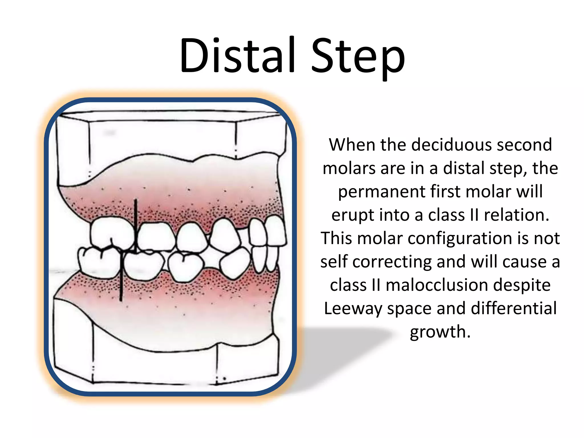 Distal Step
When the deciduous second
molars are in a distal step, the
permanent first molar will
erupt into a class II relation.
This molar configuration is not
self correcting and will cause a
class II malocclusion despite
Leeway space and differential
growth.
 