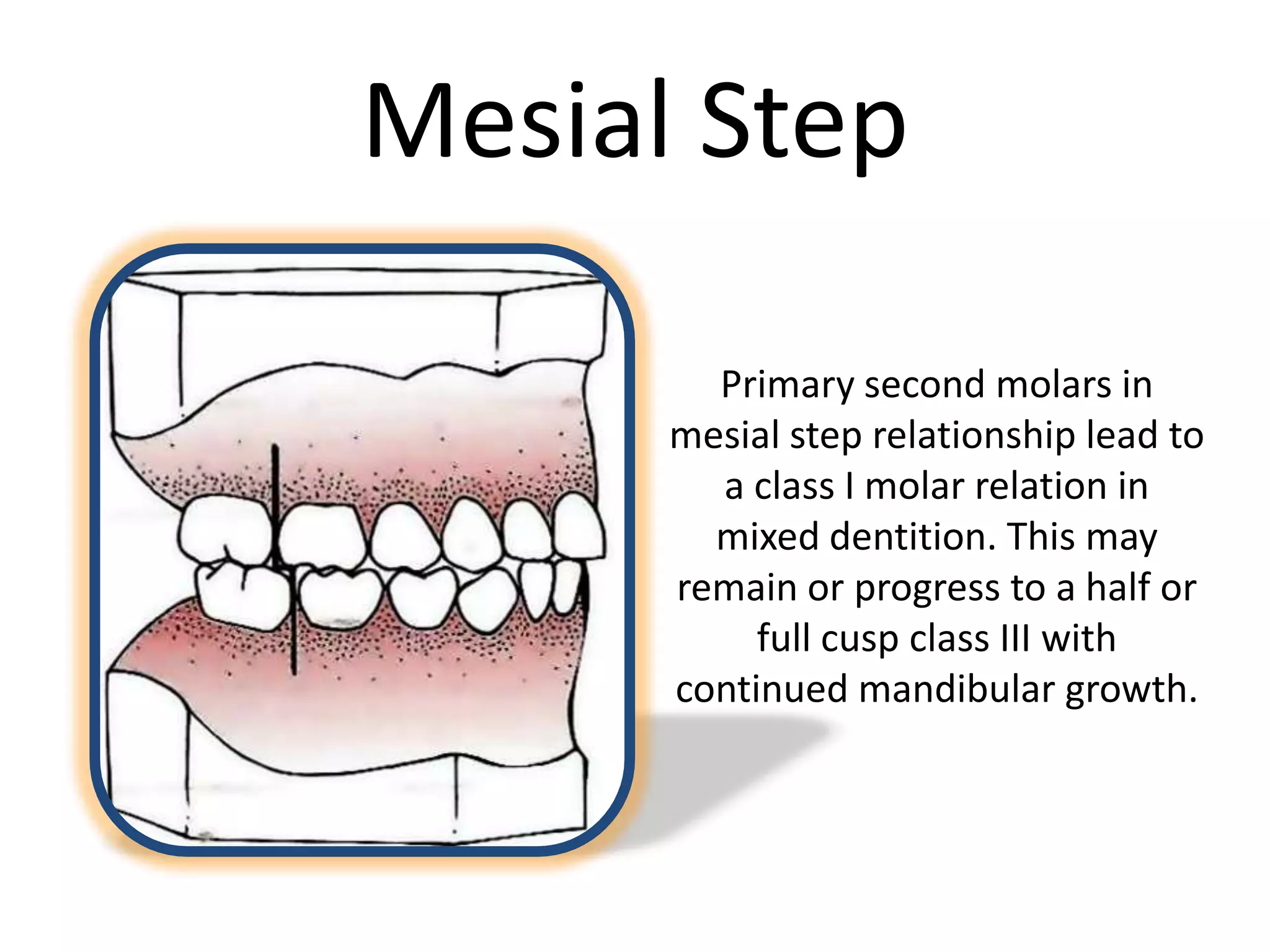 Mesial Step
Primary second molars in
mesial step relationship lead to
a class I molar relation in
mixed dentition. This may
remain or progress to a half or
full cusp class III with
continued mandibular growth.
 