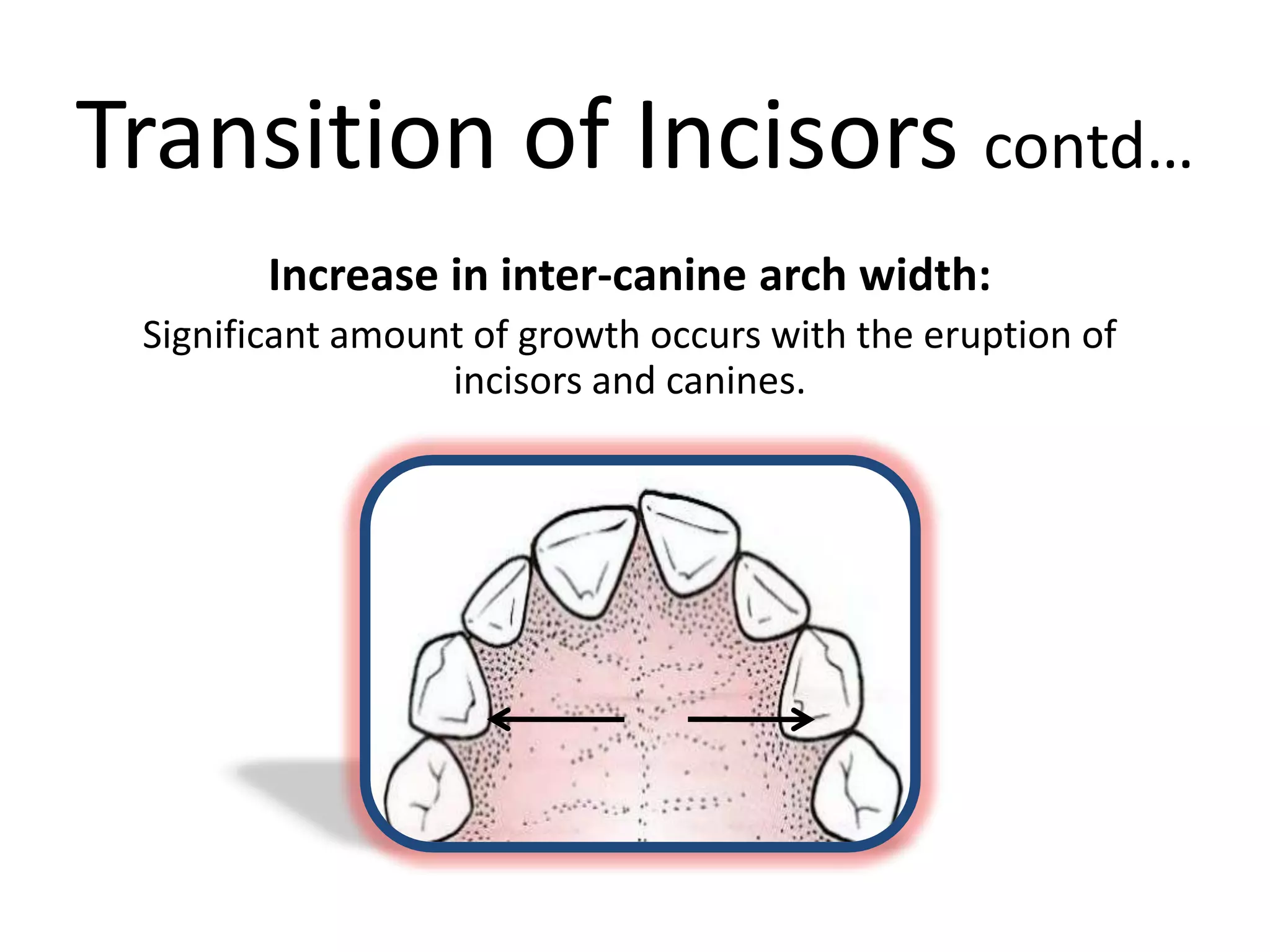 Transition of Incisors contd…
Increase in inter-canine arch width:
Significant amount of growth occurs with the eruption of
incisors and canines.
 