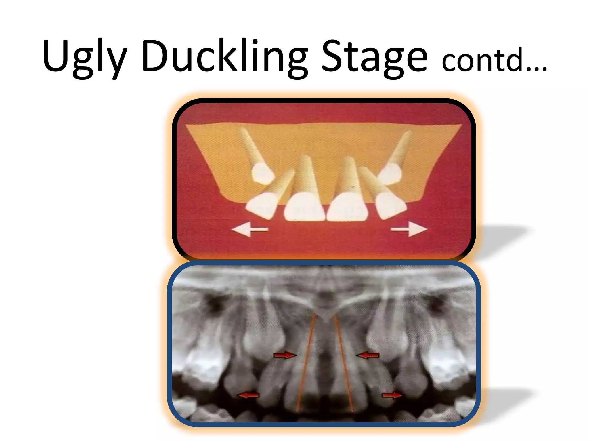 Ugly Duckling Stage contd…
 
