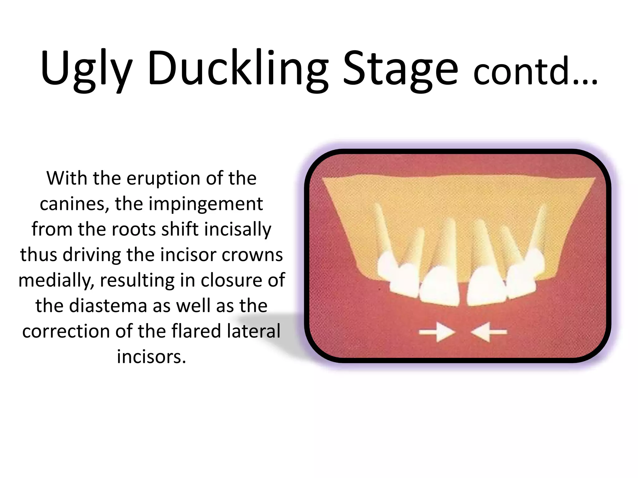 Ugly Duckling Stage contd…
With the eruption of the
canines, the impingement
from the roots shift incisally
thus driving the incisor crowns
medially, resulting in closure of
the diastema as well as the
correction of the flared lateral
incisors.
 