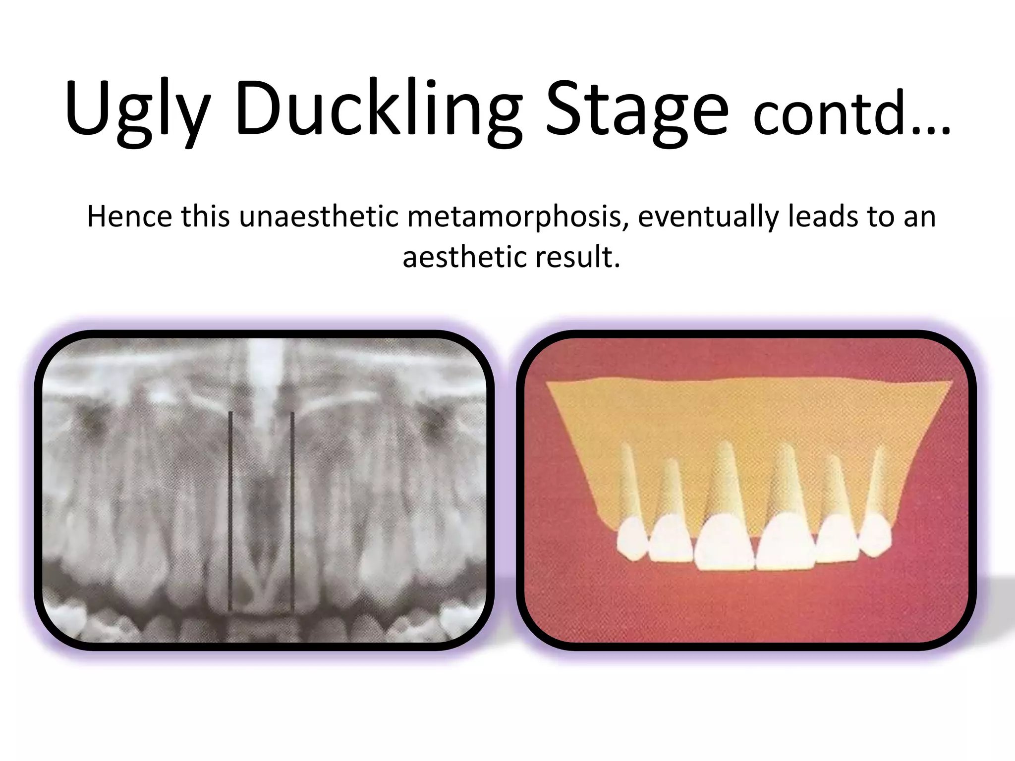 Ugly Duckling Stage contd…
Hence this unaesthetic metamorphosis, eventually leads to an
aesthetic result.
 