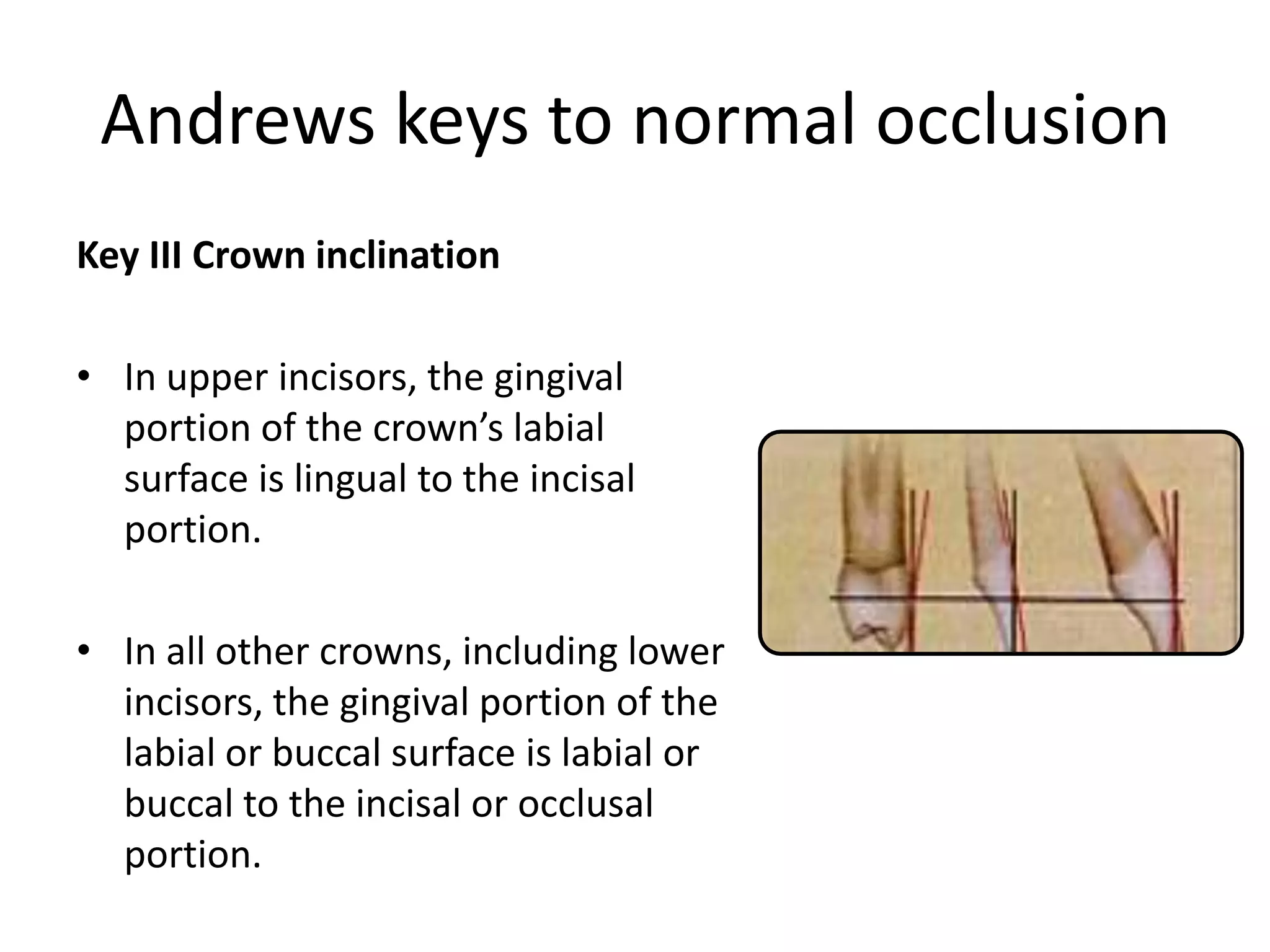 Andrews keys to normal occlusion
Key III Crown inclination
• In upper incisors, the gingival
portion of the crown’s labial
surface is lingual to the incisal
portion.
• In all other crowns, including lower
incisors, the gingival portion of the
labial or buccal surface is labial or
buccal to the incisal or occlusal
portion.
 