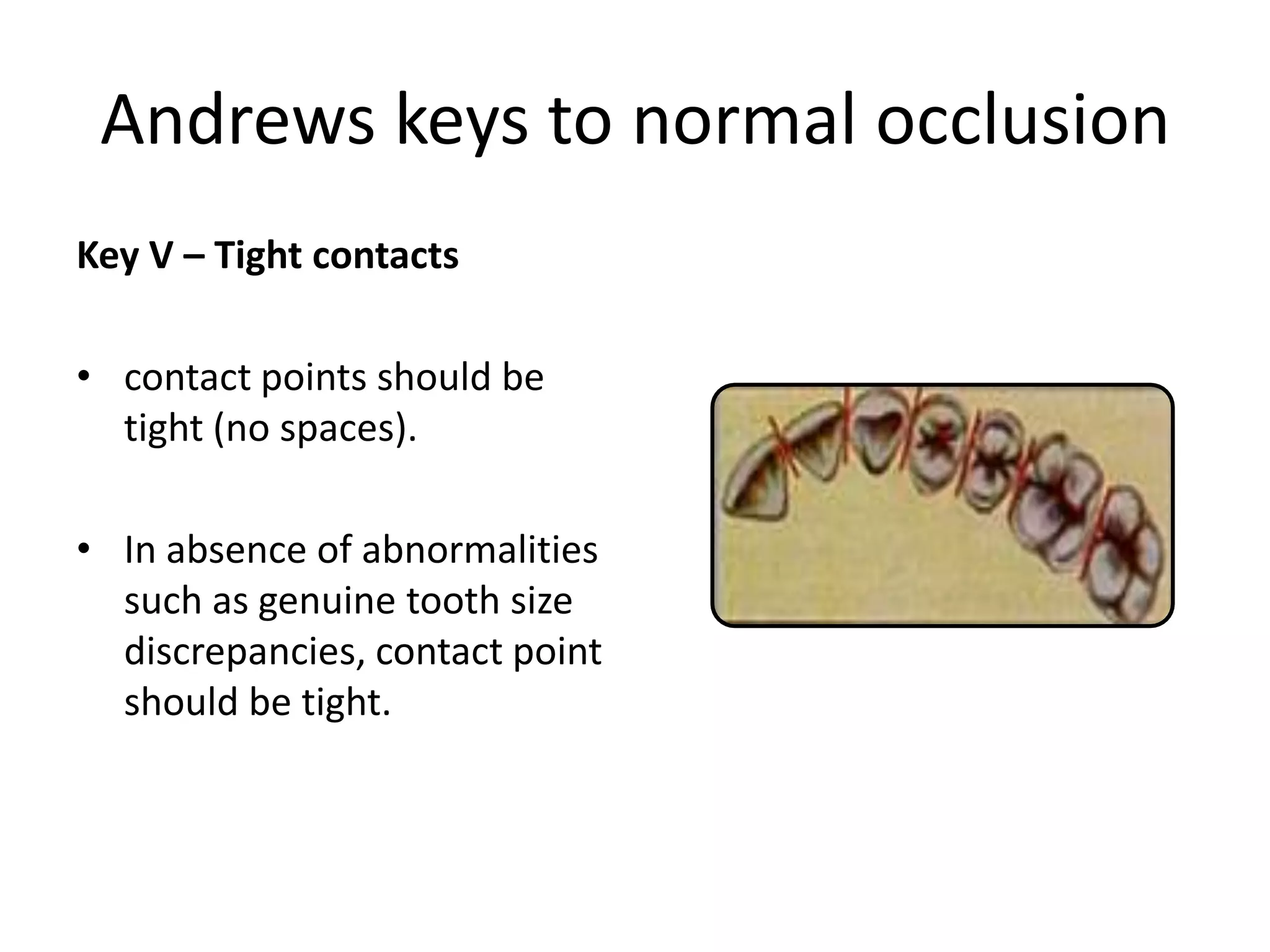 Andrews keys to normal occlusion
Key V – Tight contacts
• contact points should be
tight (no spaces).
• In absence of abnormalities
such as genuine tooth size
discrepancies, contact point
should be tight.
 
