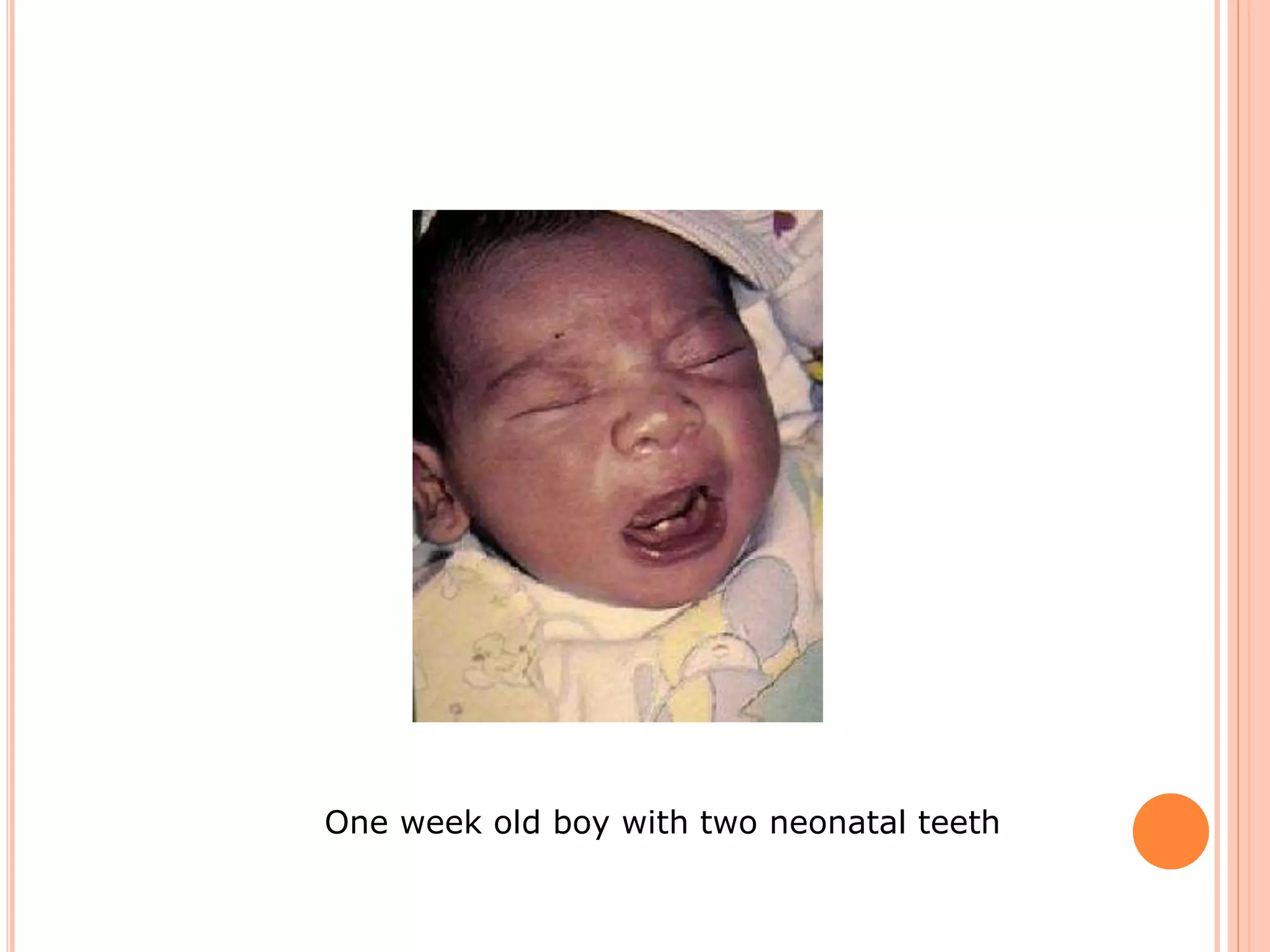 One week old boy with two neonatal teeth
 
