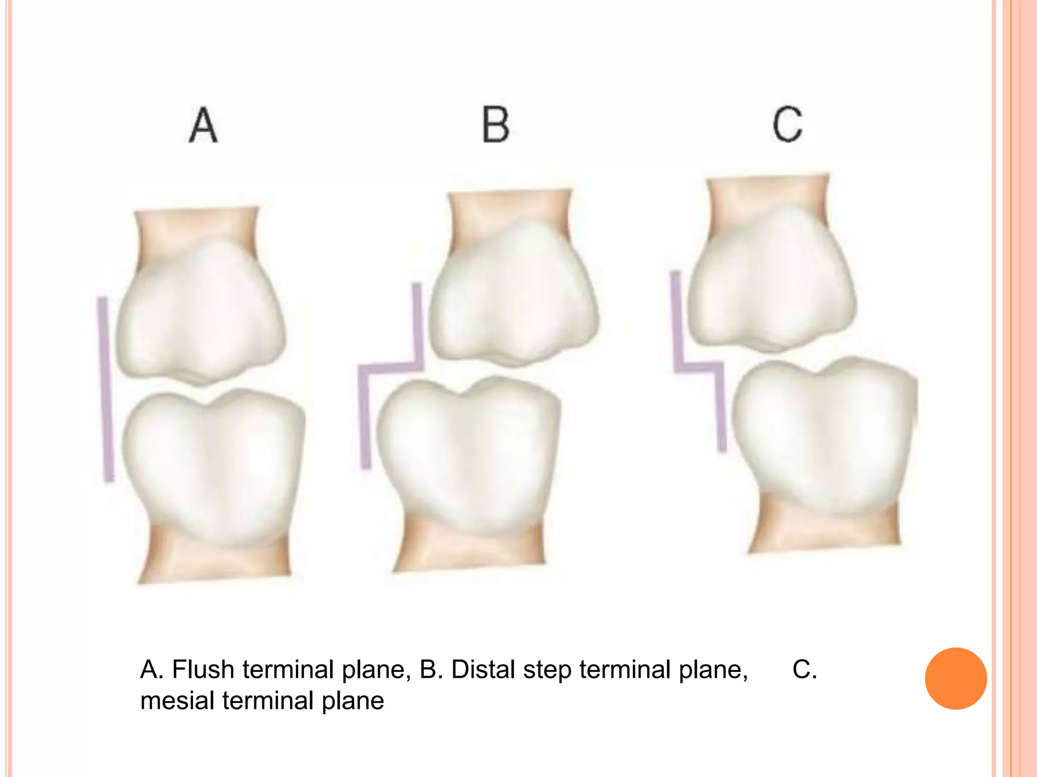 A. Flush terminal plane, B. Distal step terminal plane, C.
mesial terminal plane
 