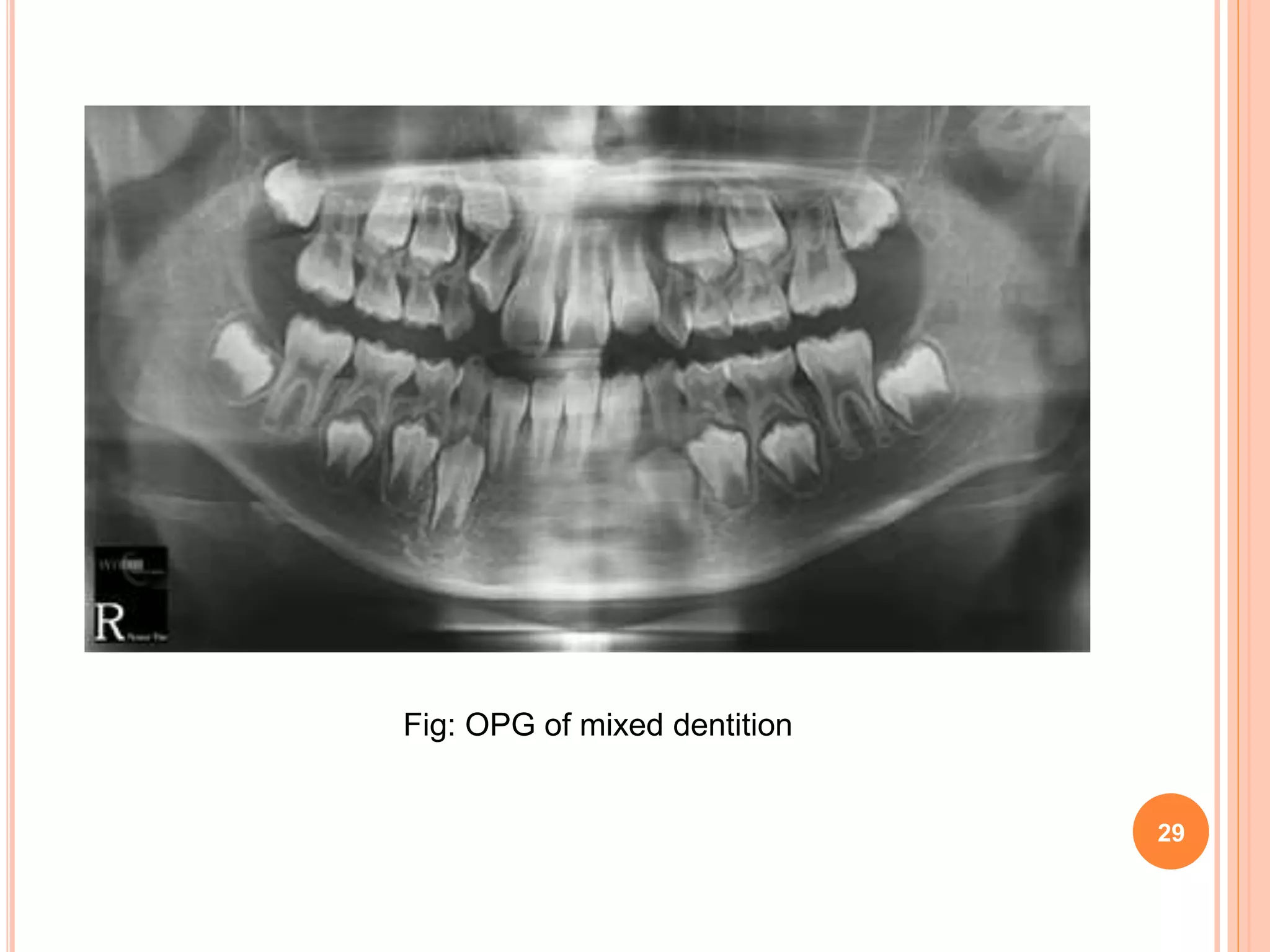 Fig: OPG of mixed dentition
29
 