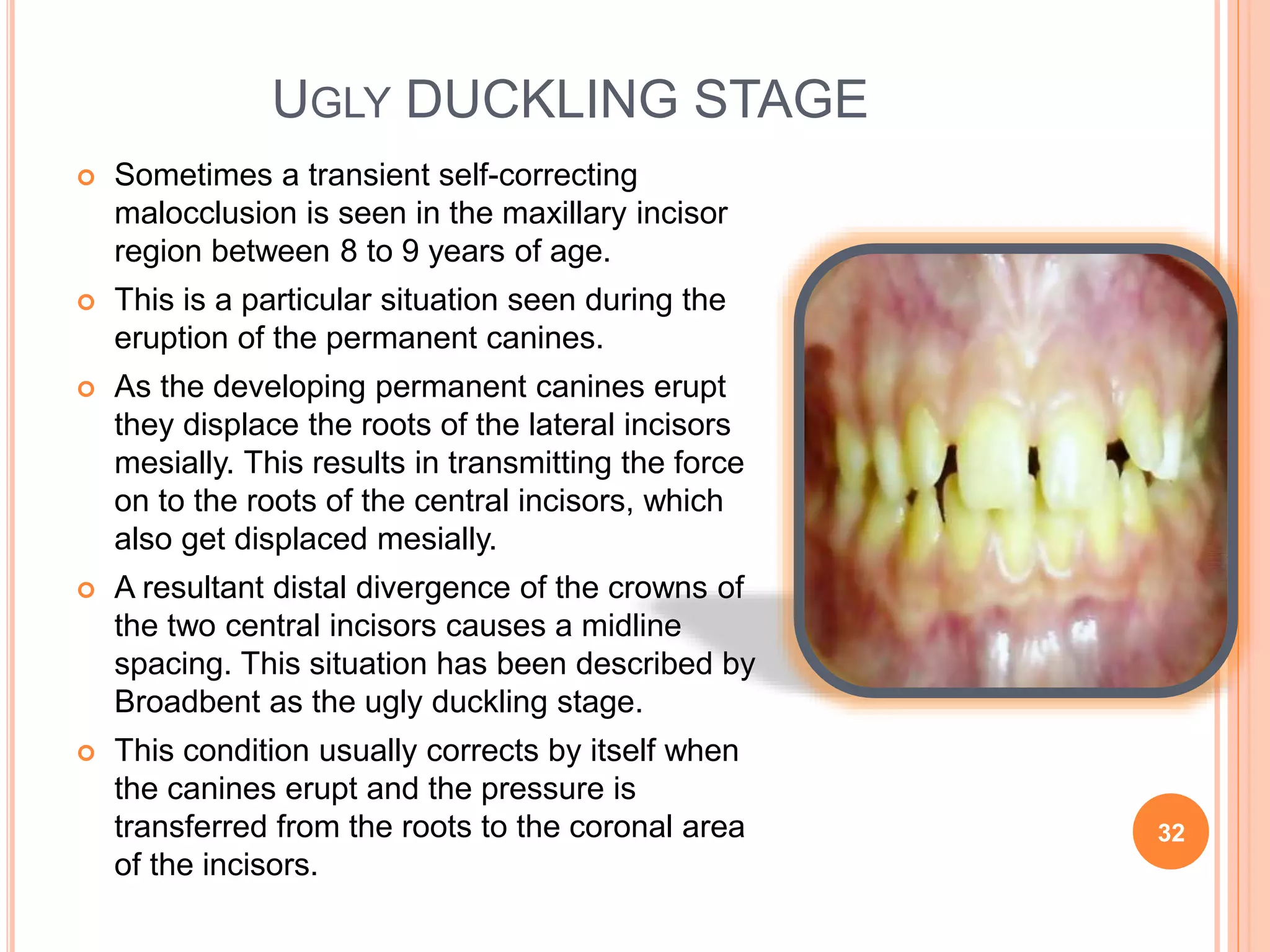 UGLY DUCKLING STAGE
 Sometimes a transient self-correcting
malocclusion is seen in the maxillary incisor
region between 8 to 9 years of age.
 This is a particular situation seen during the
eruption of the permanent canines.
 As the developing permanent canines erupt
they displace the roots of the lateral incisors
mesially. This results in transmitting the force
on to the roots of the central incisors, which
also get displaced mesially.
 A resultant distal divergence of the crowns of
the two central incisors causes a midline
spacing. This situation has been described by
Broadbent as the ugly duckling stage.
 This condition usually corrects by itself when
the canines erupt and the pressure is
transferred from the roots to the coronal area
of the incisors.
32
 