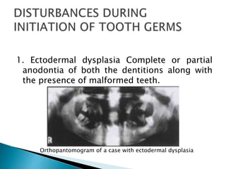 1. Ectodermal dysplasia Complete or partial
anodontia of both the dentitions along with
the presence of malformed teeth.
Orthopantomogram of a case with ectodermal dysplasia
 