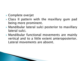  Complete overjet
 Class II pattern with the maxillary gum pad
being more prominent.
 Mandibular lateral sulci posterior to maxillary
lateral sulci.
 Mandibular functional movements are mainly
vertical and to a little extent anteroposterior.
Lateral movements are absent.
 