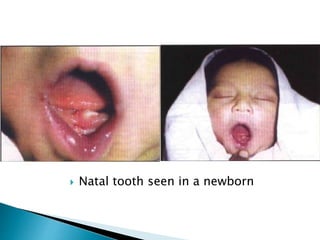  Natal tooth seen in a newborn
 