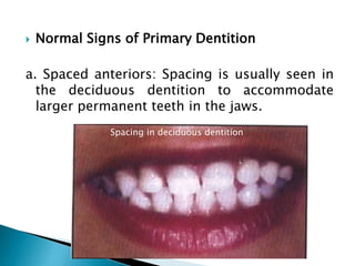  Normal Signs of Primary Dentition
a. Spaced anteriors: Spacing is usually seen in
the deciduous dentition to accommodate
larger permanent teeth in the jaws.
Spacing in deciduous dentition
 