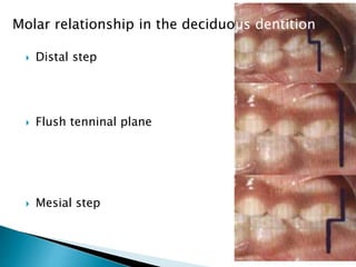  Distal step
 Flush tenninal plane
 Mesial step
Molar relationship in the deciduous dentition
 