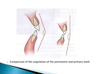  Comparison of the angulation of the permanent and primary teeth
 
