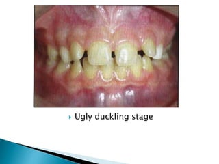  Ugly duckling stage
 