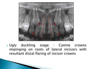  Ugly duckling stage : Canine crowns
impinging on roots of lateral incisors with
resultant distal flaring of incisor crowns
 