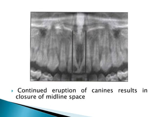  Continued eruption of canines results in
closure of midline space
 