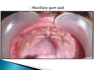 Maxillary gum pad
 