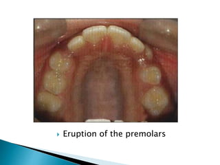  Eruption of the premolars
 